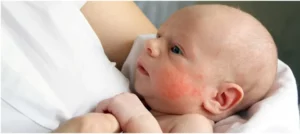 Baby Milk Allergy Symptoms
